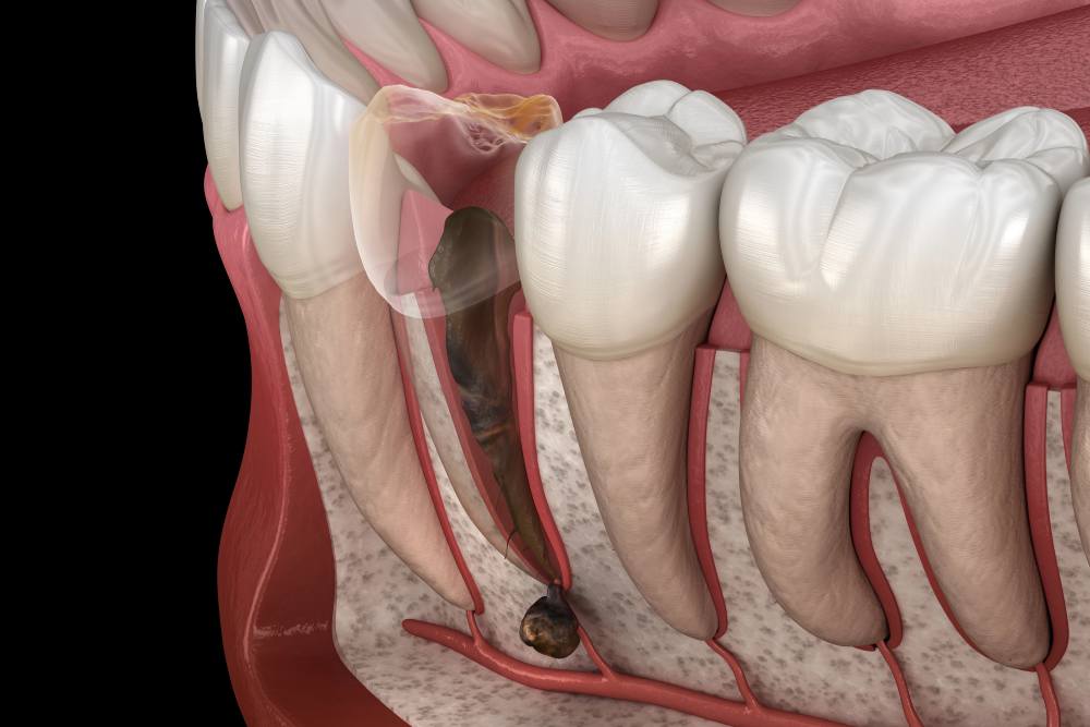 Natural temporary Relief only Remedies To Easing tooth pain Symptoms