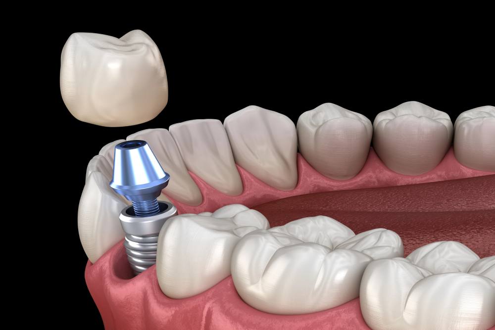 Dental Implants: What Do They Look Like?