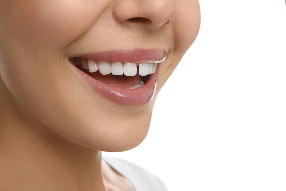How To Get Rid Of A Teeth Gap: Effective Solutions