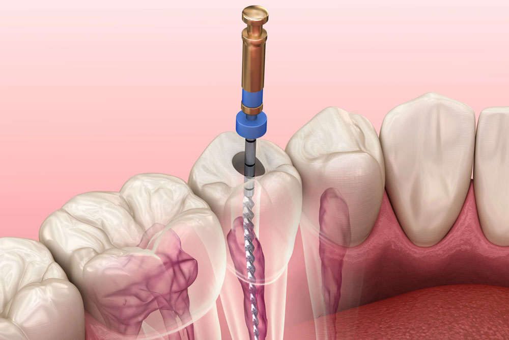 How Do You Know If You Need A Root Canal? 7 Signs To Look For