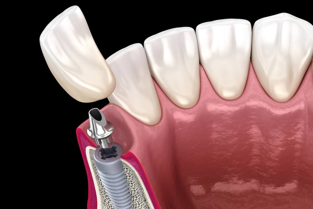 Understanding The Types Of Dental Implants