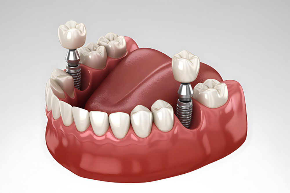 Discovering 10 Benefits Of Dental Implants