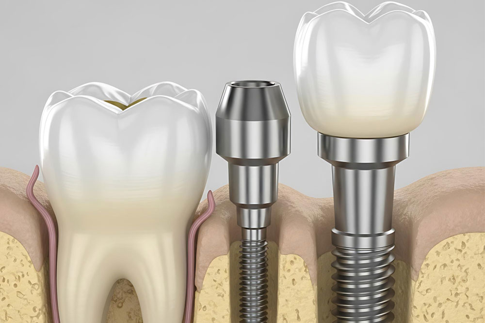 Dental Implant Procedure: How Long Does It Take?