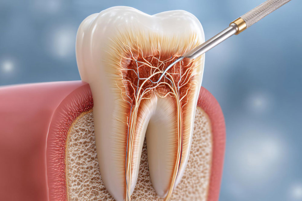 How Does A Root Canal Work? Understanding The Procedure