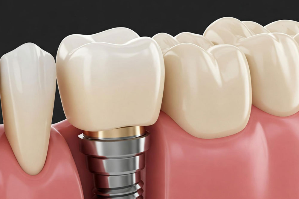 How To Get Dental Implants And Ensure Proper Healing