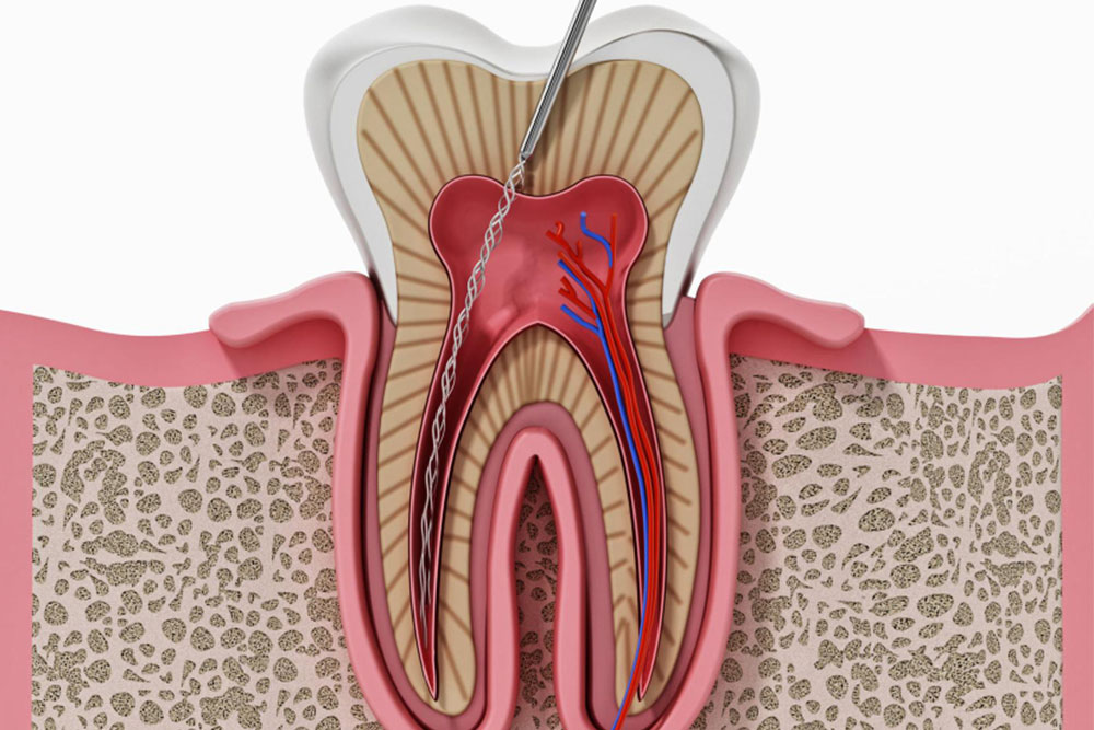 Root Canal Without A Crown: How Long Can It Really Last?